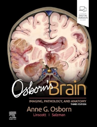 Osborns Brain